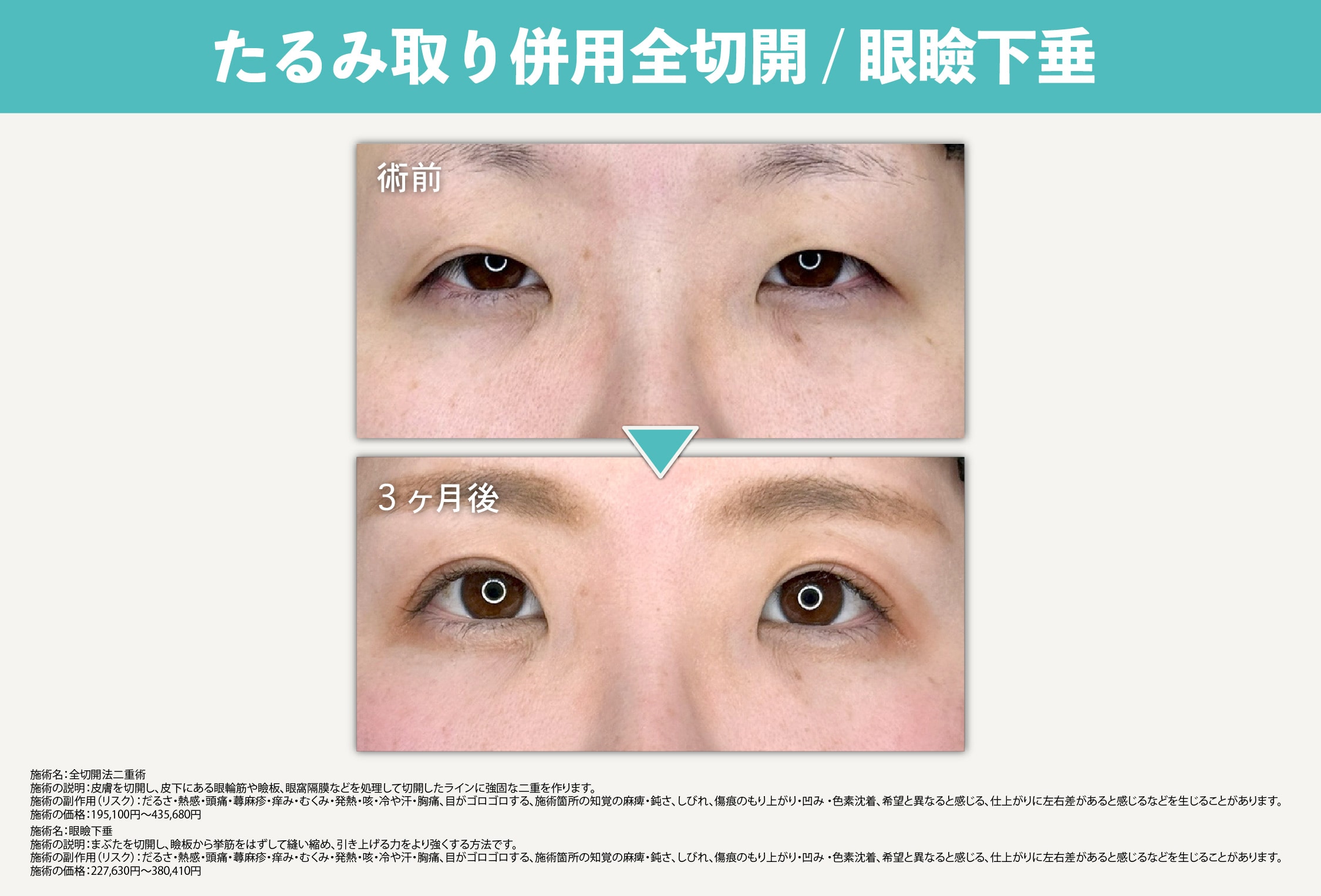 山口医師によるたるみ取り併用全切開二重術/眼瞼下垂