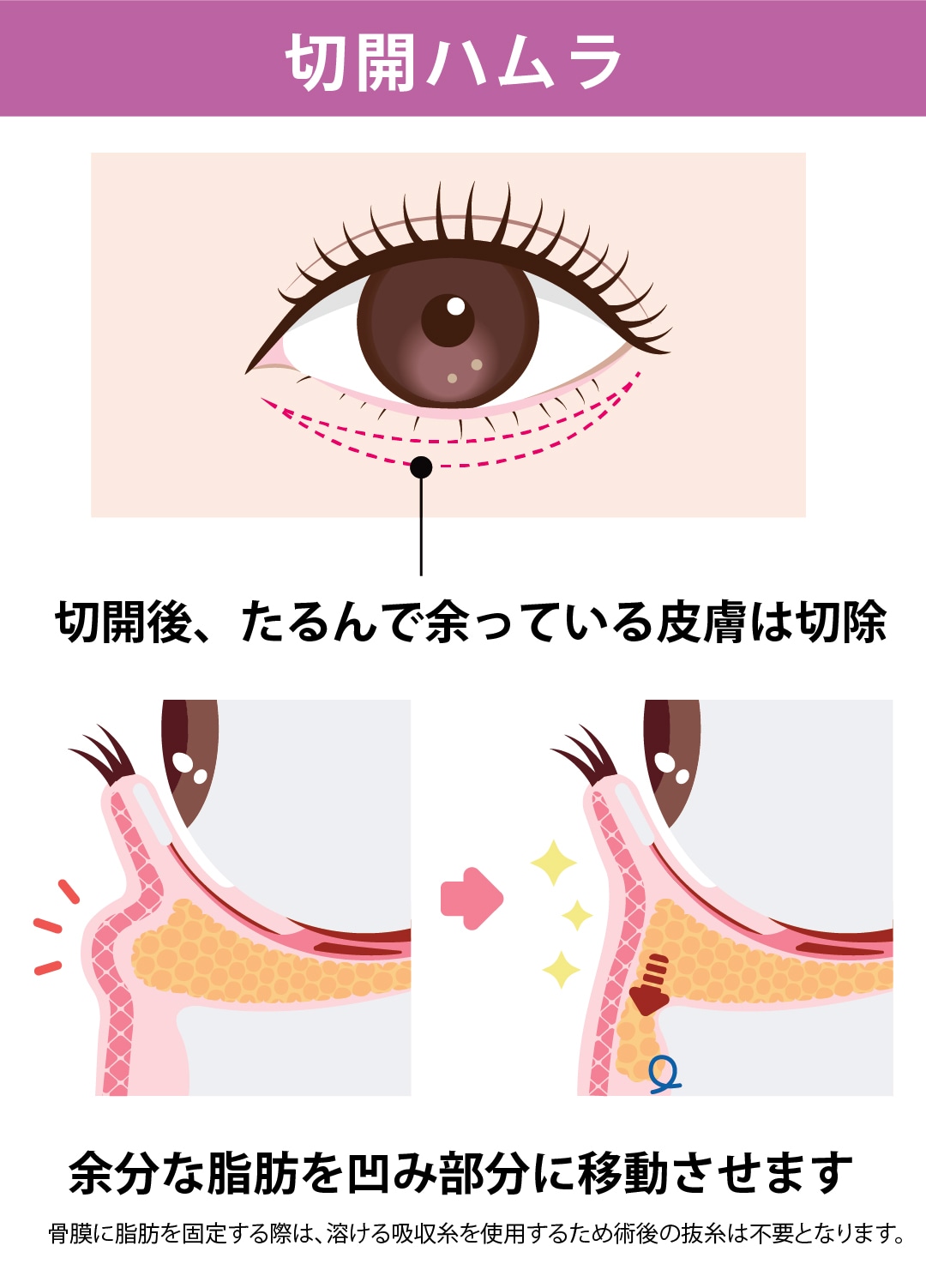 切開ハムラ法（表ハムラ法）：たるみとシワも同時に改善