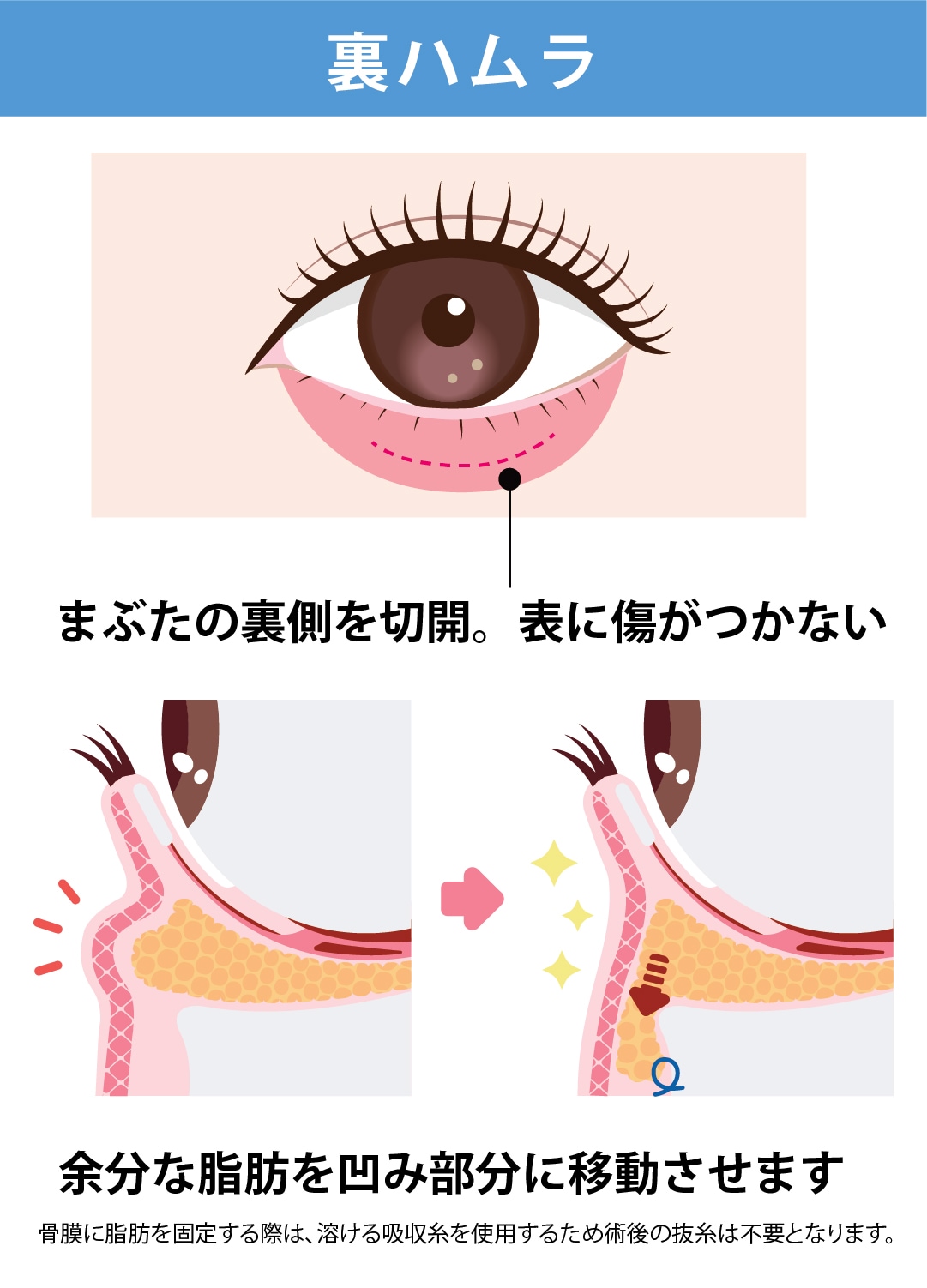 裏ハムラ法：傷跡が見えない自然な仕上がり