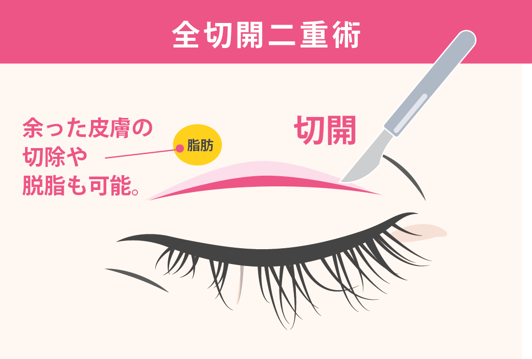 切開をして二重ラインを形成する方法