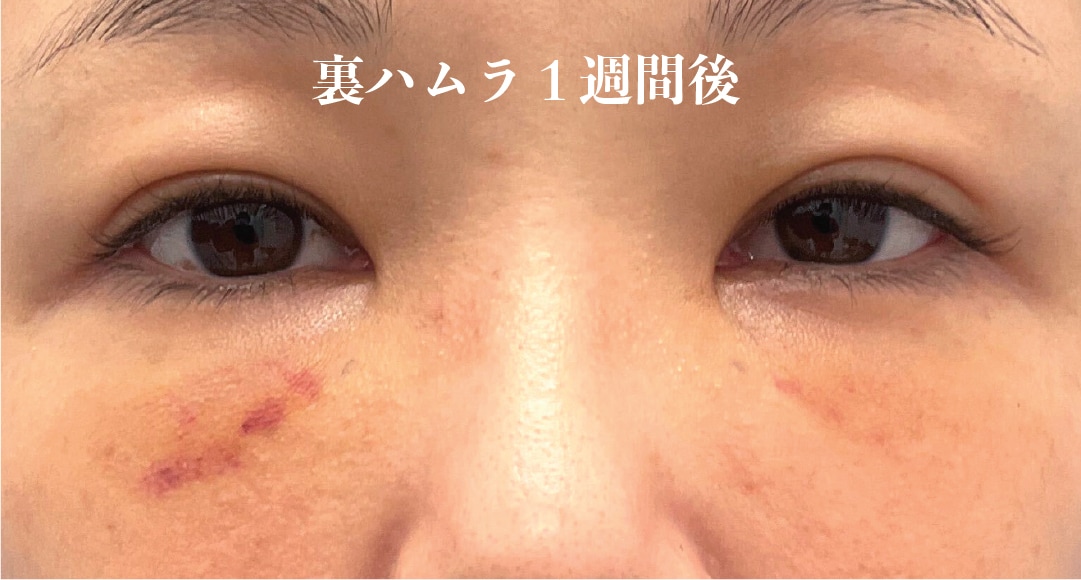 裏ハムラ法のダウンタイム