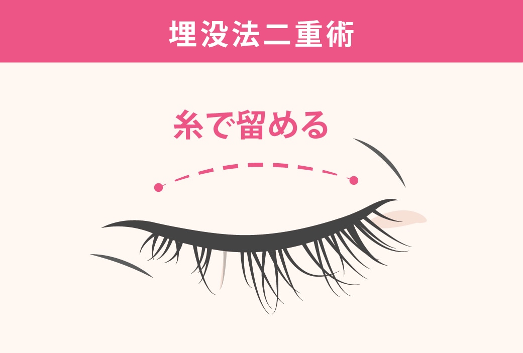 切らずに糸で二重を作る方法