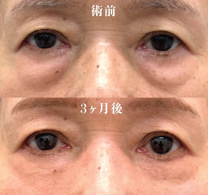 【70代女性】切開ハムラ法