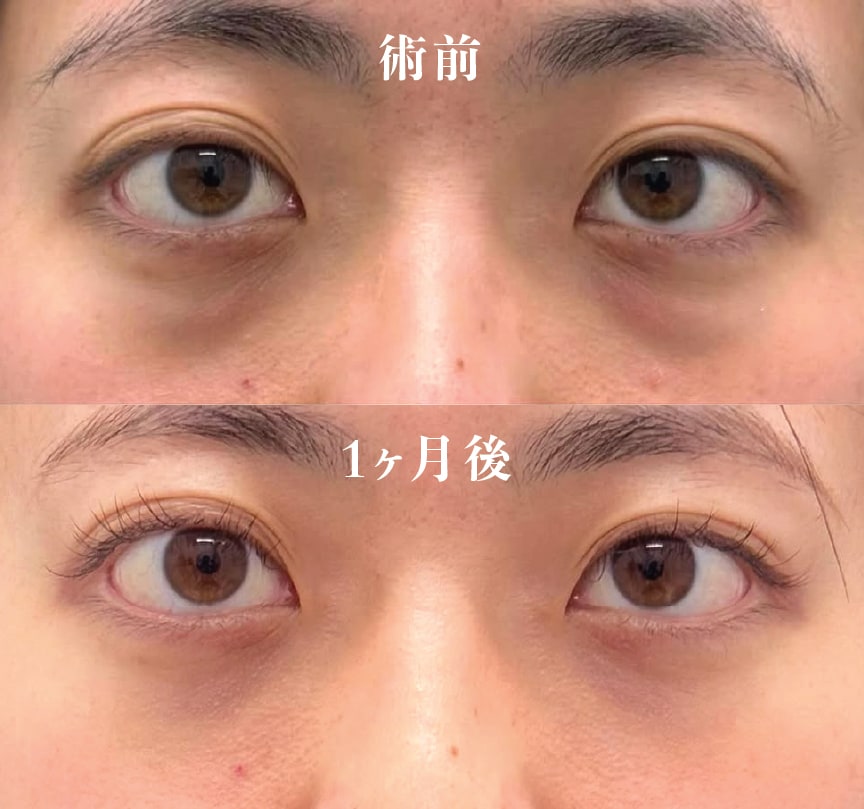 【20代女性】裏ハムラ法