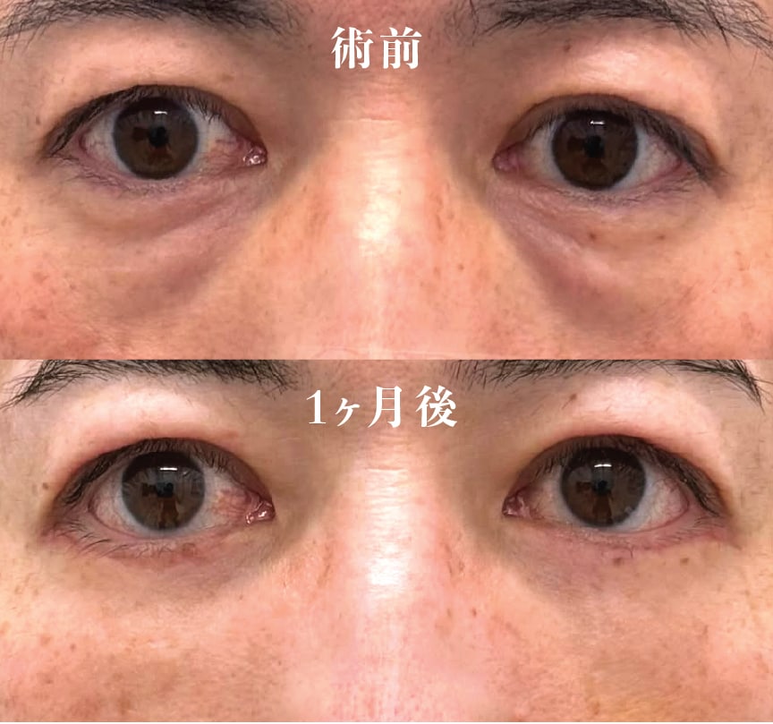 【30代男性】切開ハムラ法