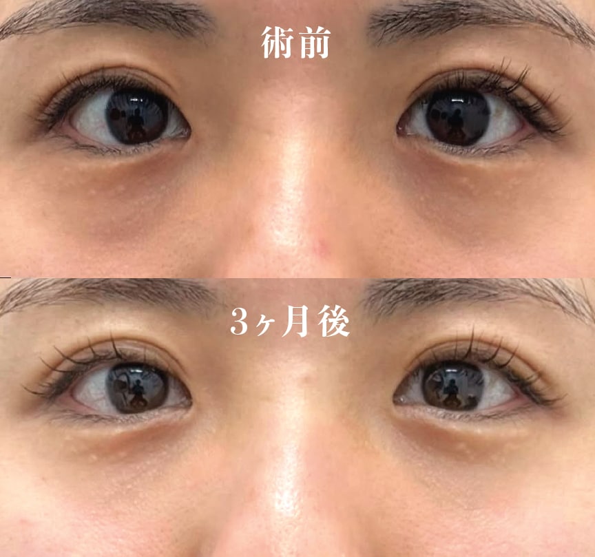 【20代女性】裏ハムラ法