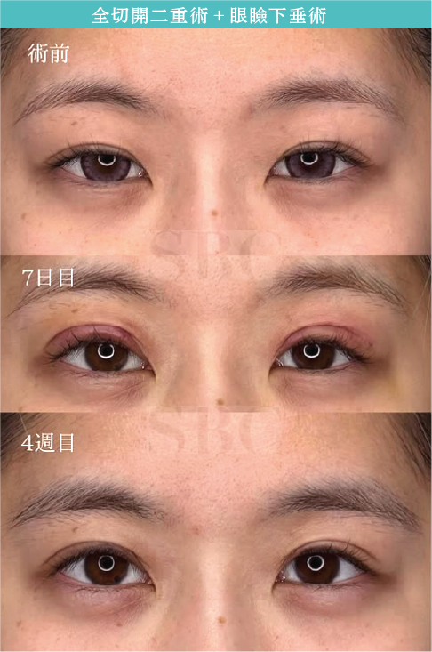 全切開二重術のダウンタイムはどのくらい？
