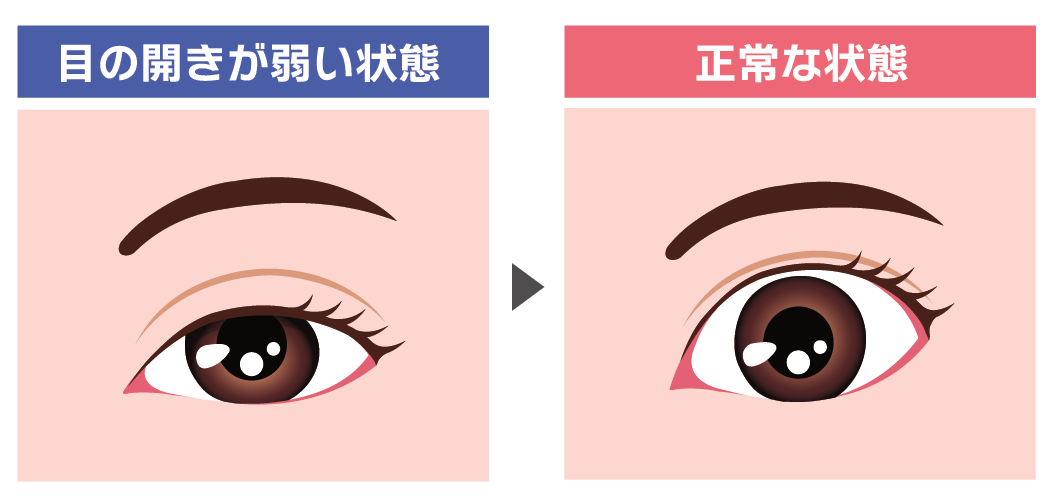目の開きを改善するなら「眼瞼下垂術」の併用がおすすめ！