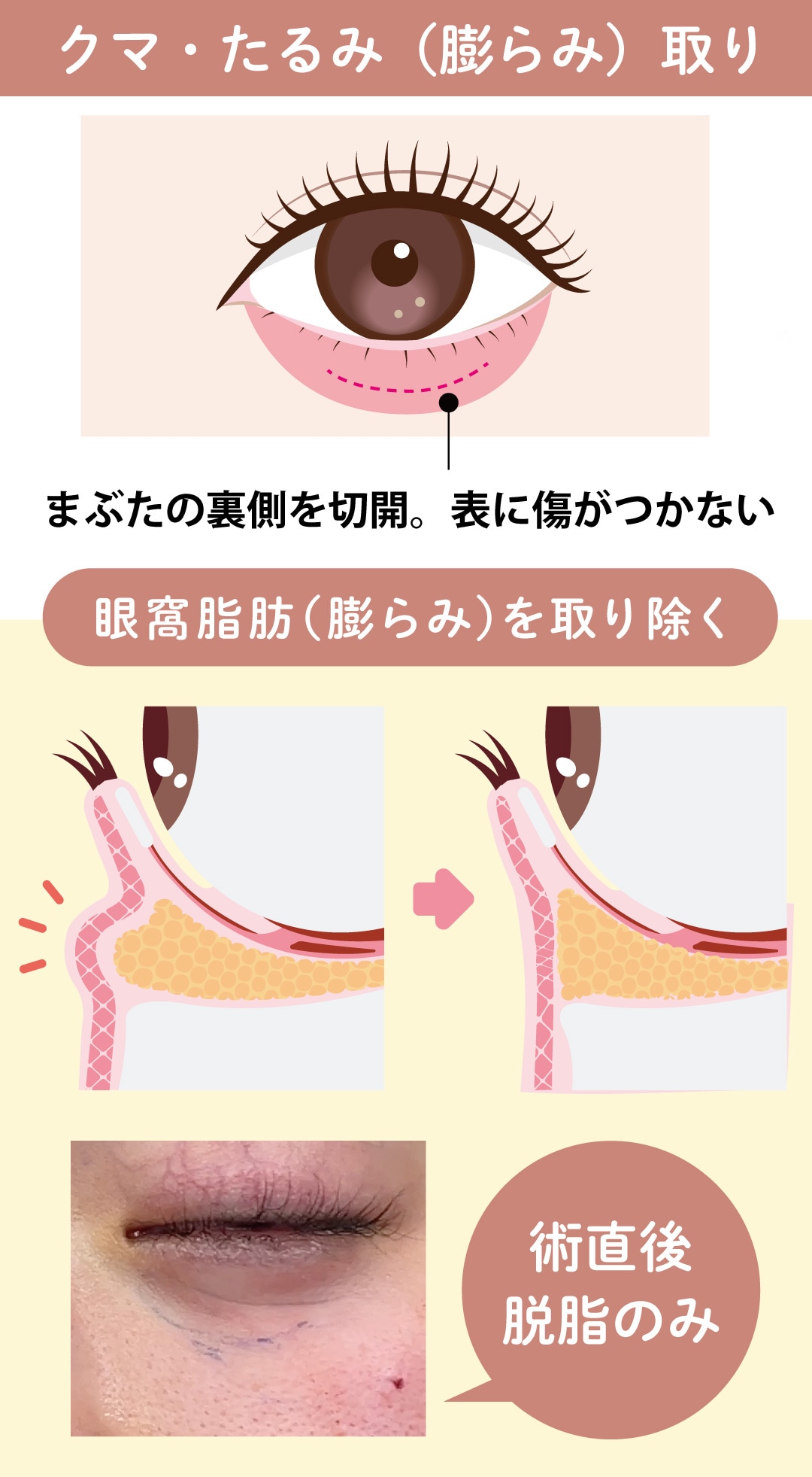 目の下の切らないクマ・たるみ・膨らみ取り