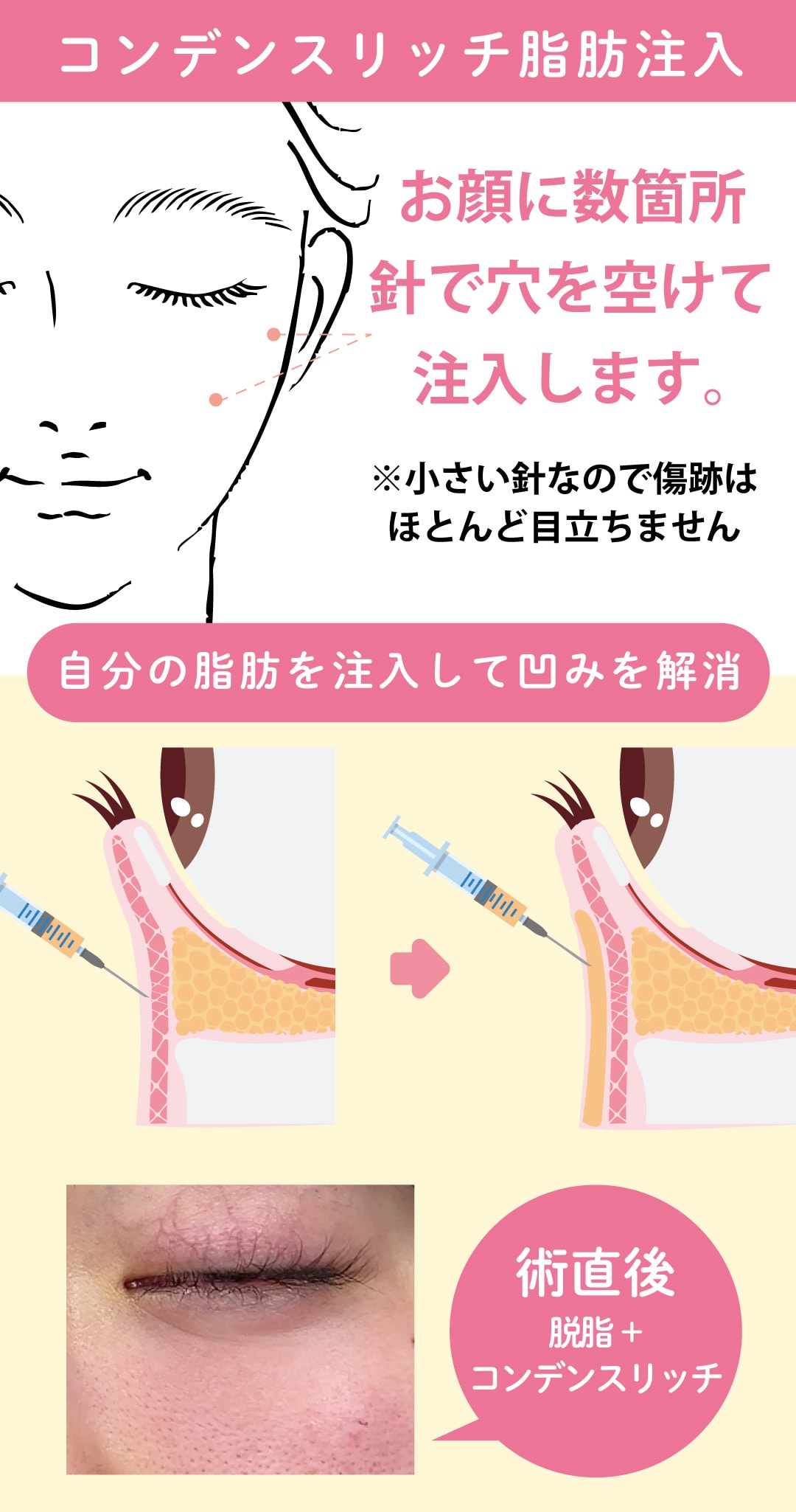 脂肪注入:コンデンスリッチ【凹み改善】