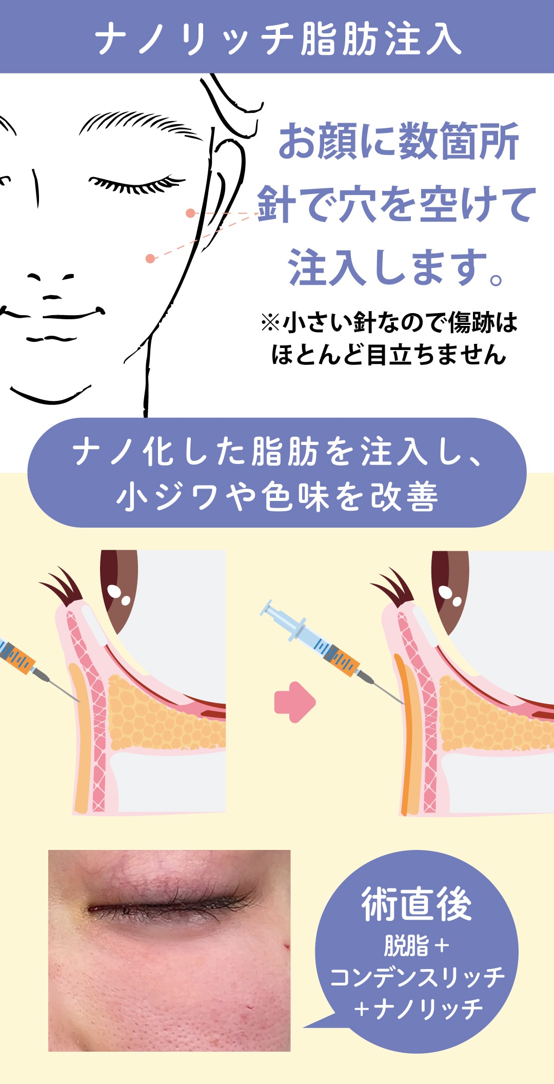 脂肪注入:脂肪注入注射ナノリッチ【色味・小ジワ・窪み改善】