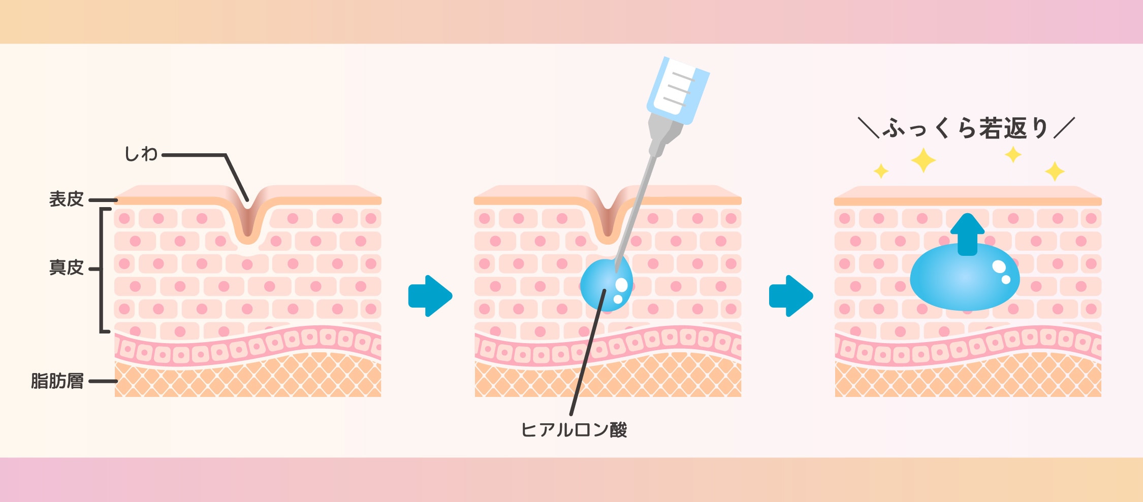そもそもヒアルロン酸って?