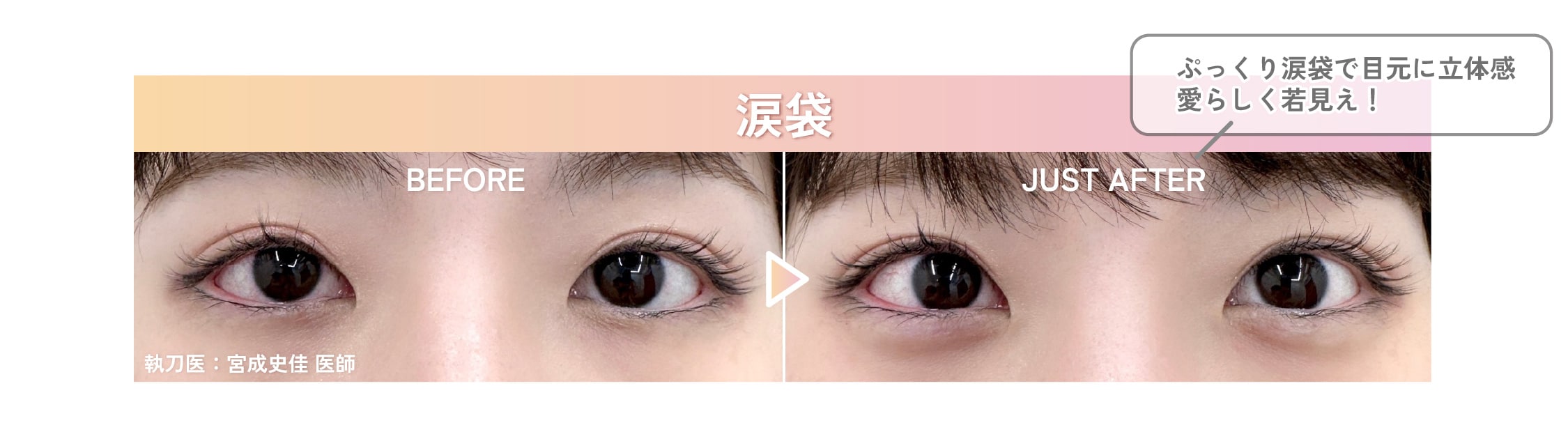 涙袋