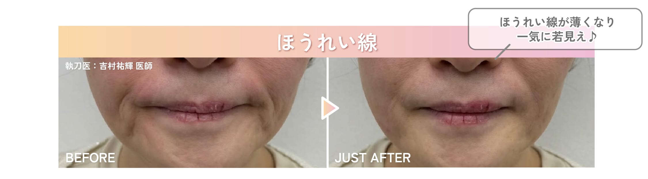 ほうれい線