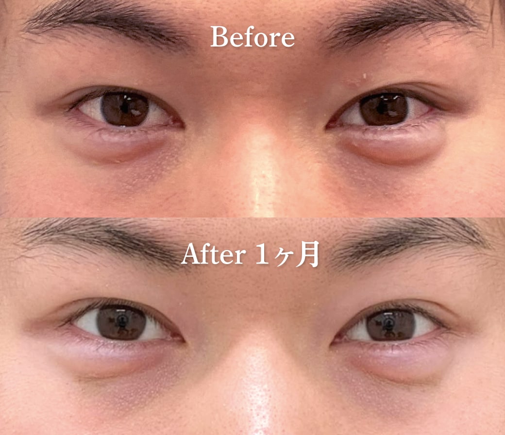 【10代男性】全切開二重術・眼瞼下垂術