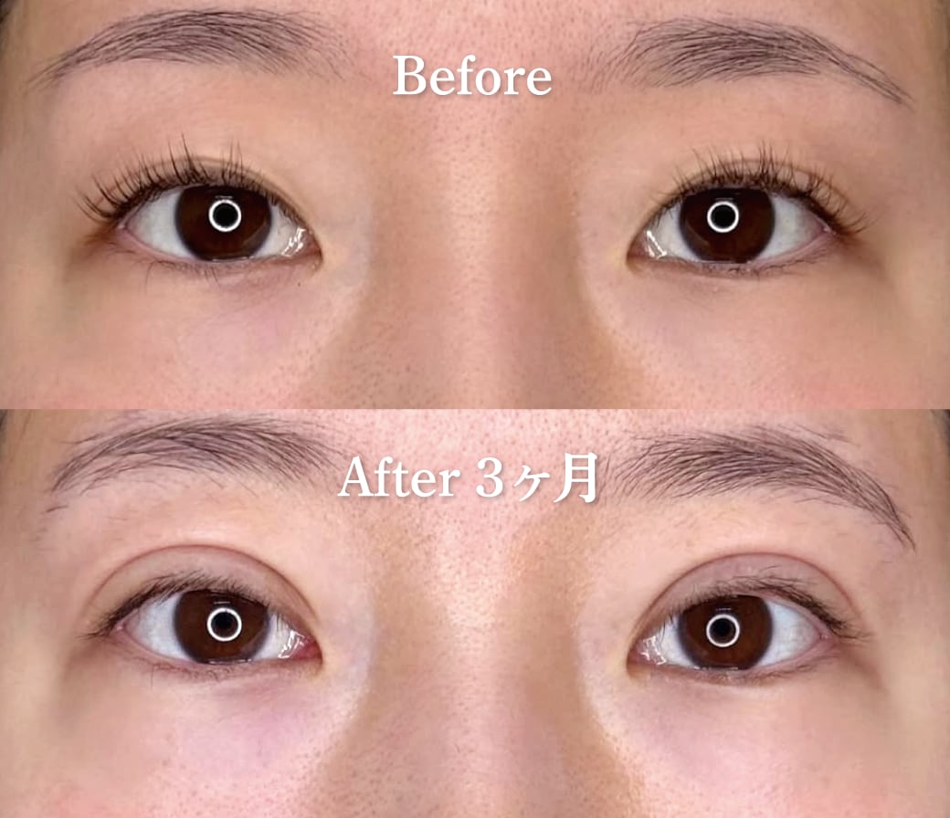 【20代女性】全切開二重術