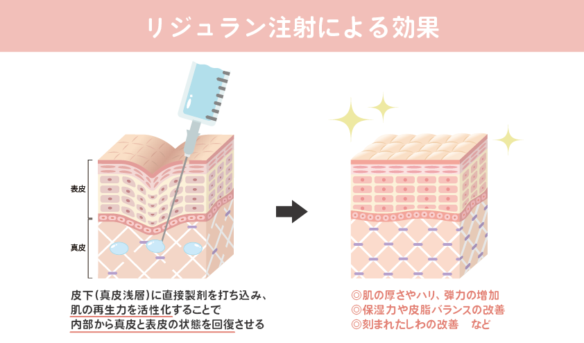 リジュラン注射の効果