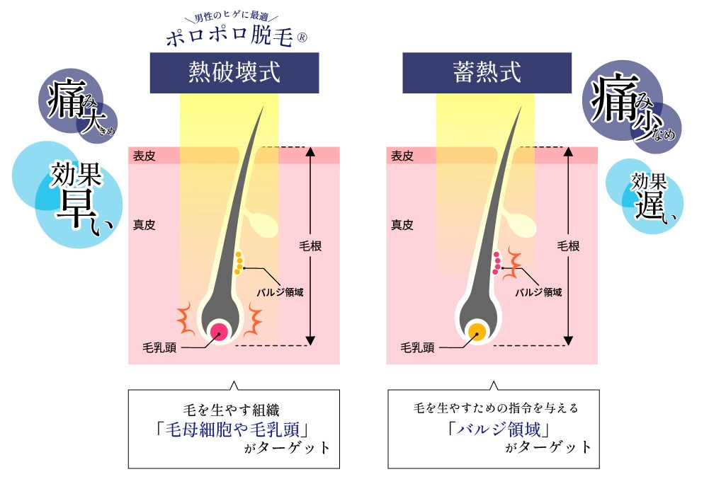 脱毛の仕組み