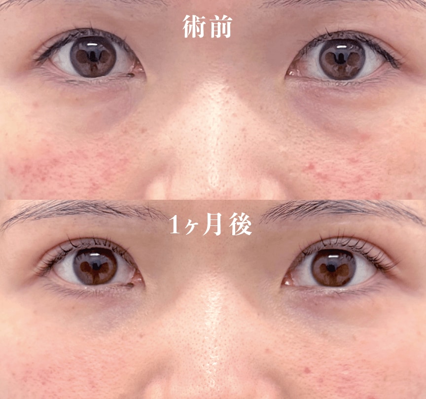 【20代女性】裏ハムラ法・クイックコスメティークトリプル