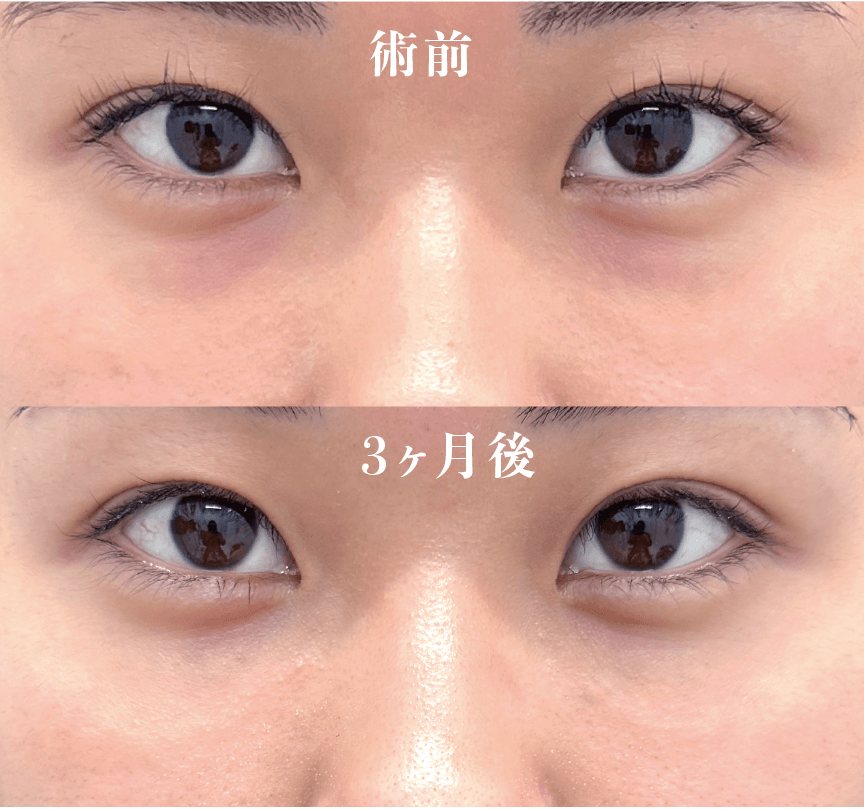 【20代女性】裏ハムラ法