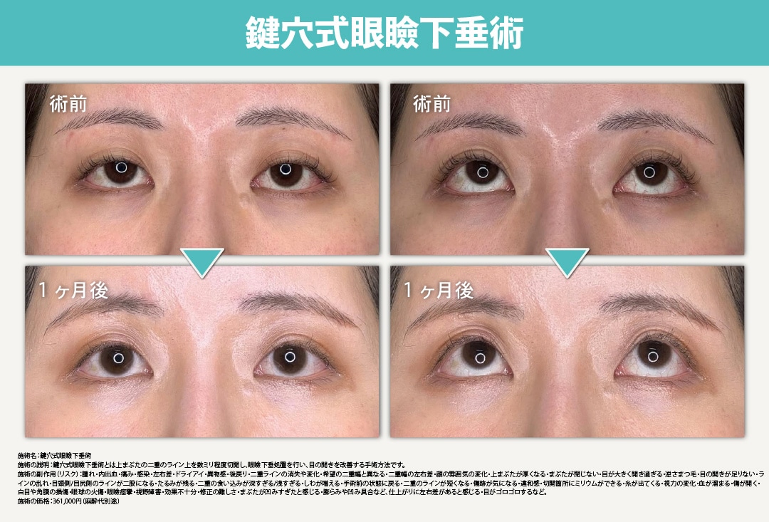 山口医師による鍵穴式眼瞼下垂術