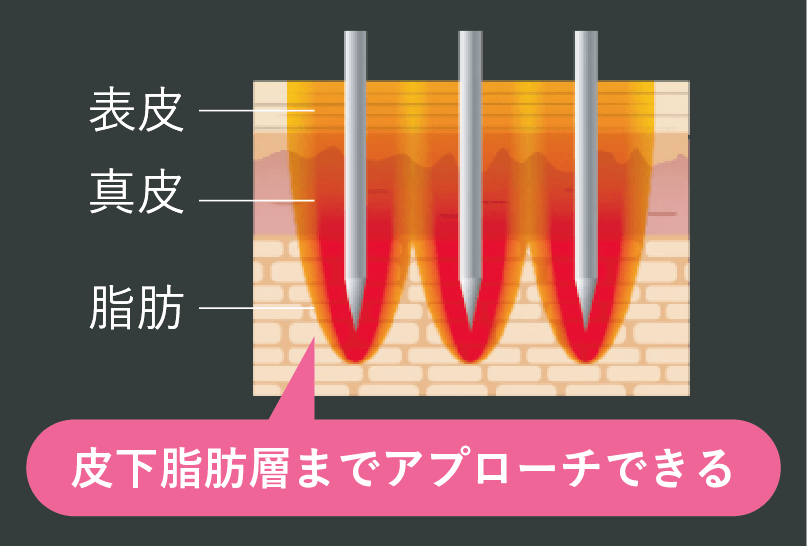 モフィウス8とは？なぜ目の下のたるみに効くの？