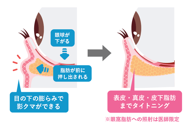 そもそも目の下のぷっくりしたクマの正体は…