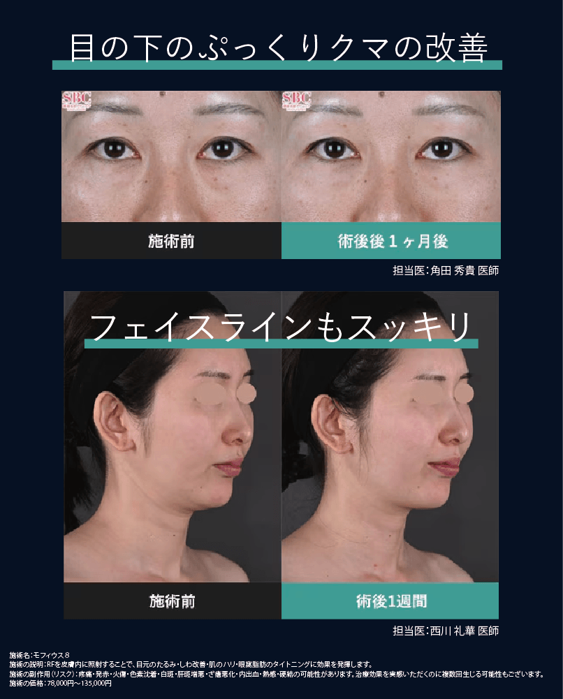 クマ改善だけじゃない！フェイスラインにもおすすめ！