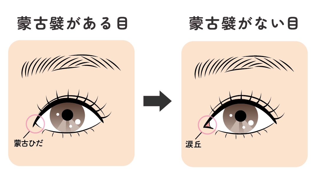 目頭切開とは？ なぜ目が大きくなるの？