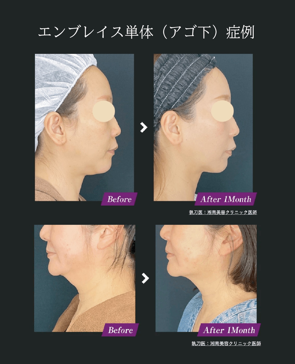 エンブレイス単体の症例