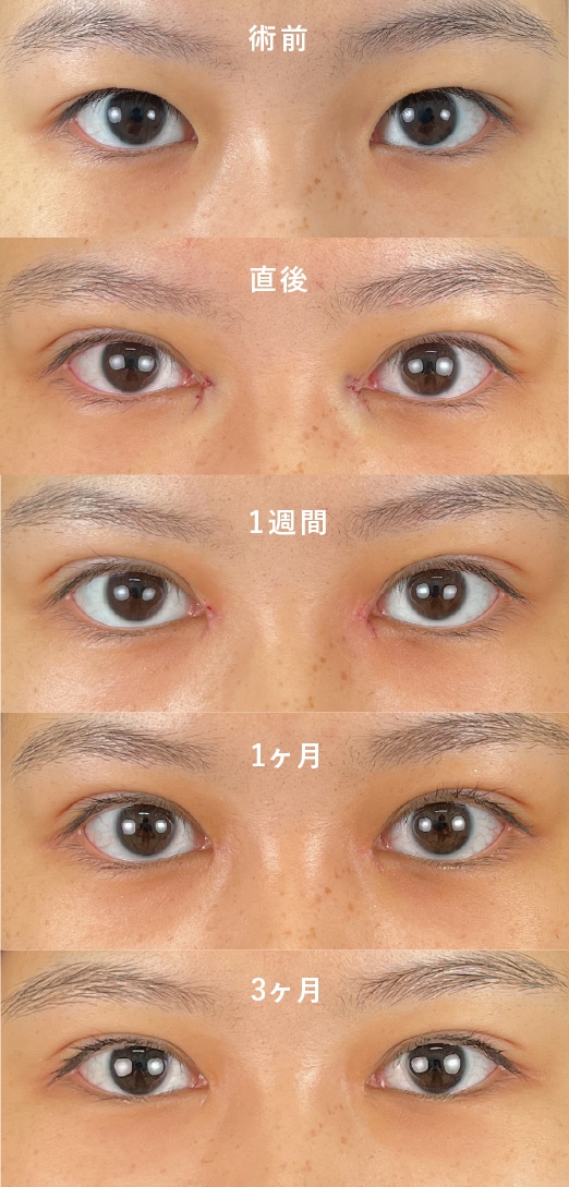 直後〜3ヶ月の症例
