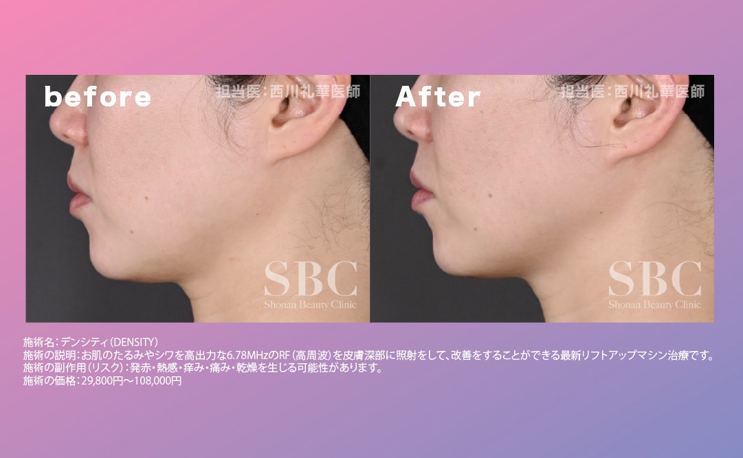 フェイスラインのたるみ改善！小ジワハリ感UP！