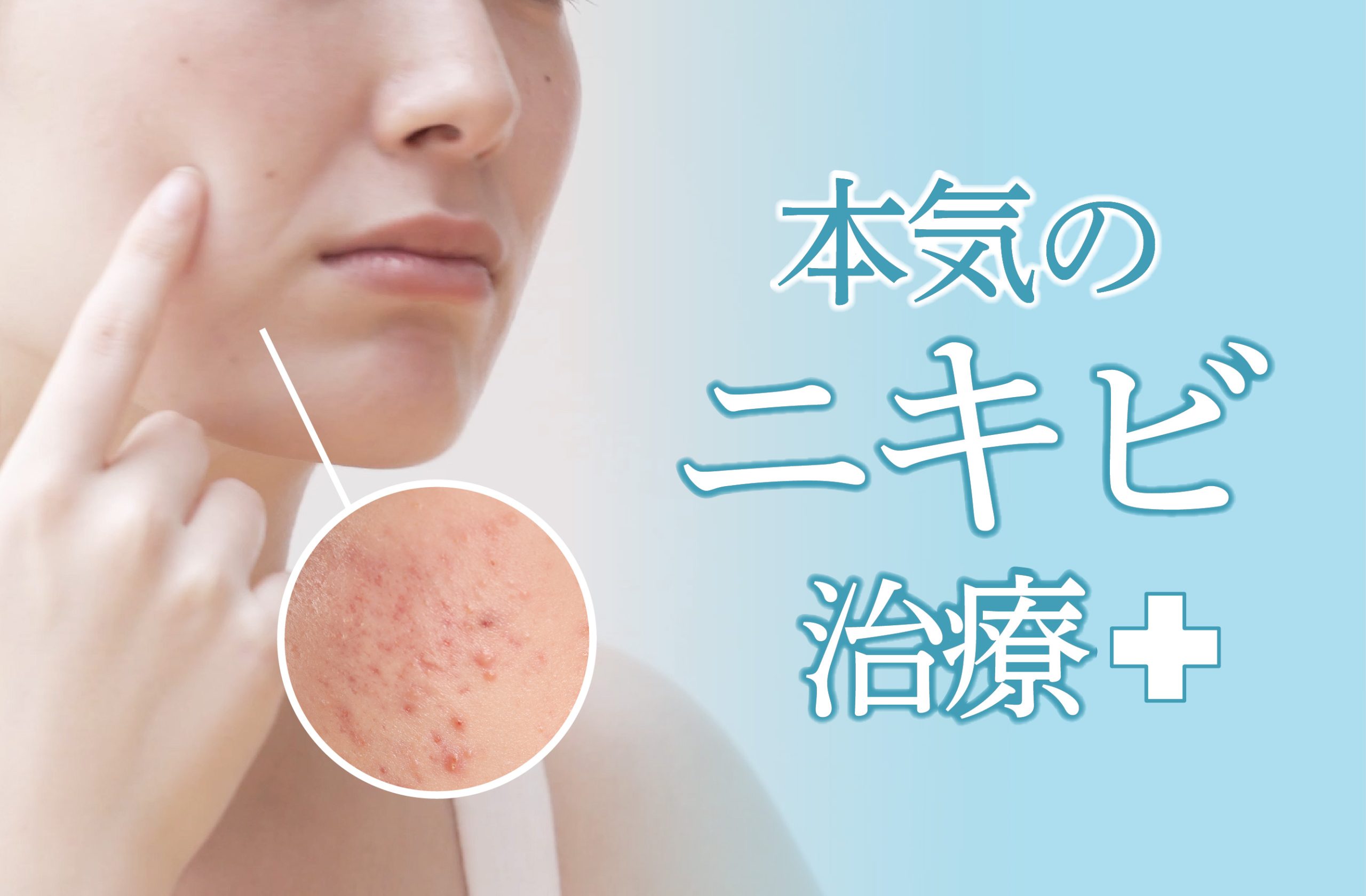 【福岡・天神】もうニキビで悩まない！原因から最新治療まで徹底解説｜ニキビ治療なら湘南美容クリニック福岡院