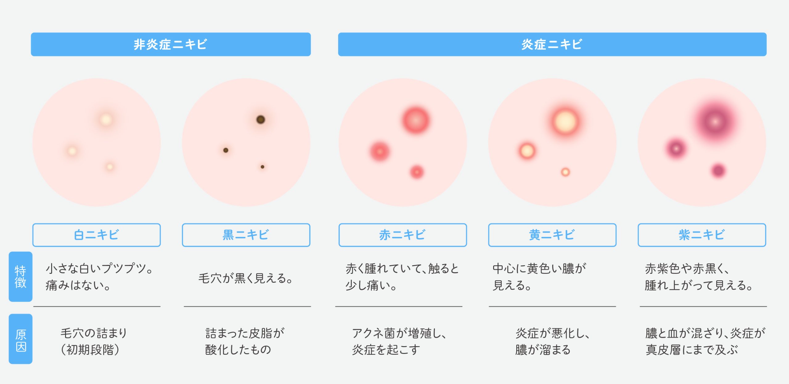あなたはどのタイプ？ニキビの種類別セルフチェック