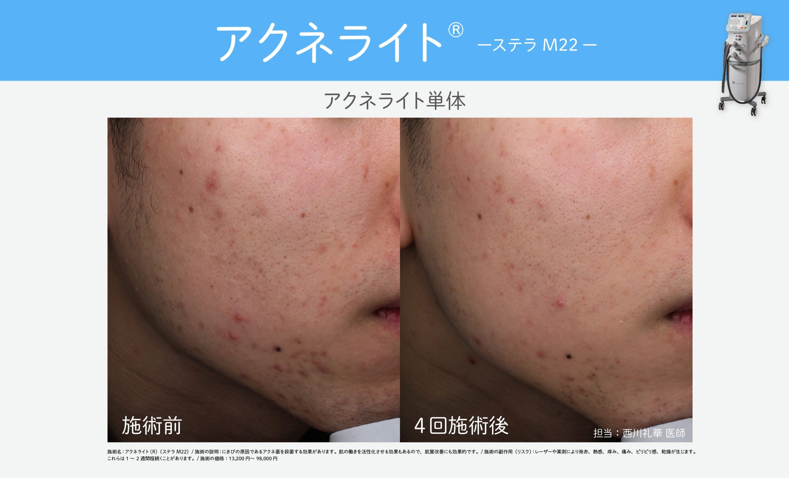 炎症ニキビを集中殺菌【アクネライト】