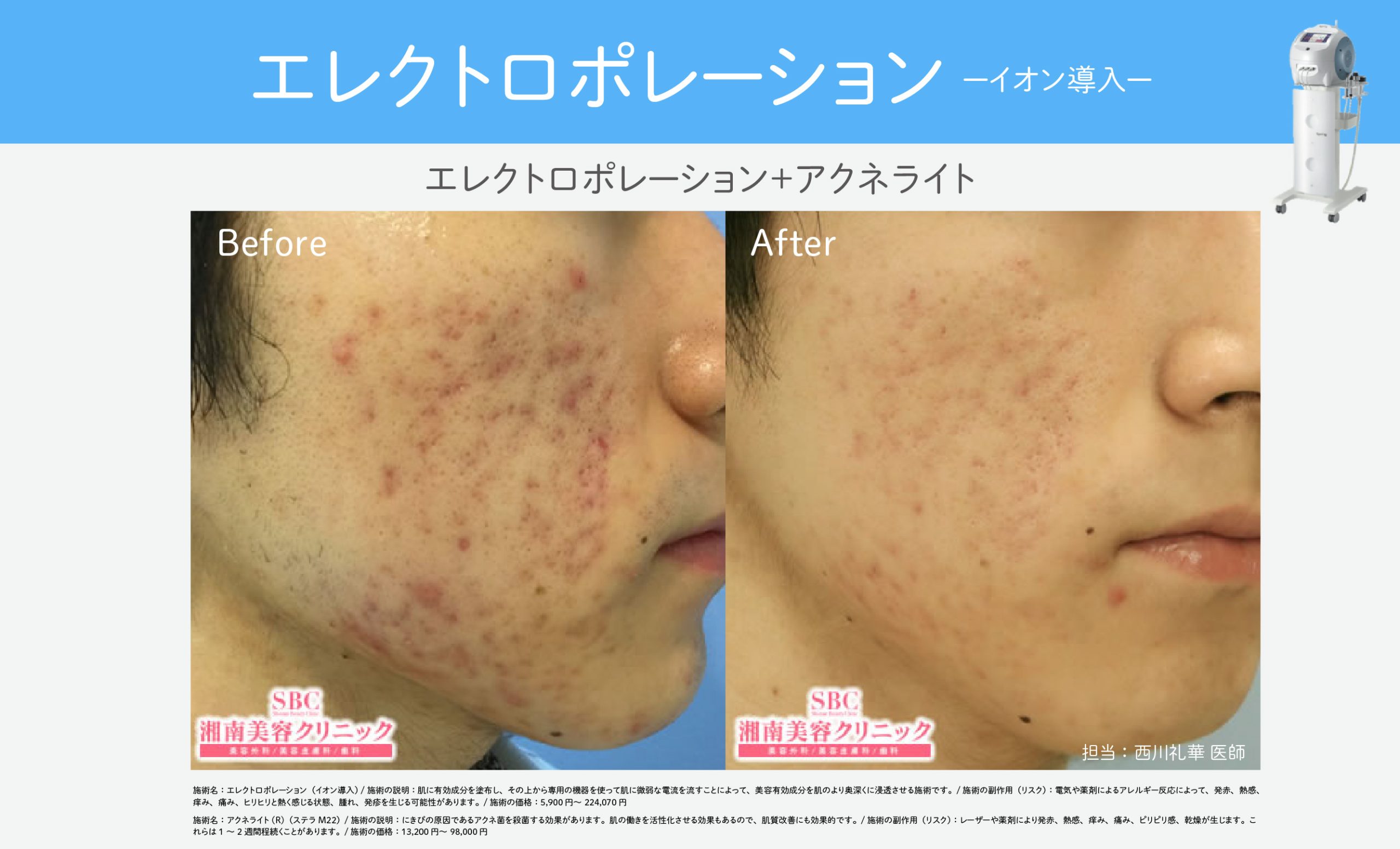 美肌成分を肌の奥へ届ける【エレクトロポレーション】