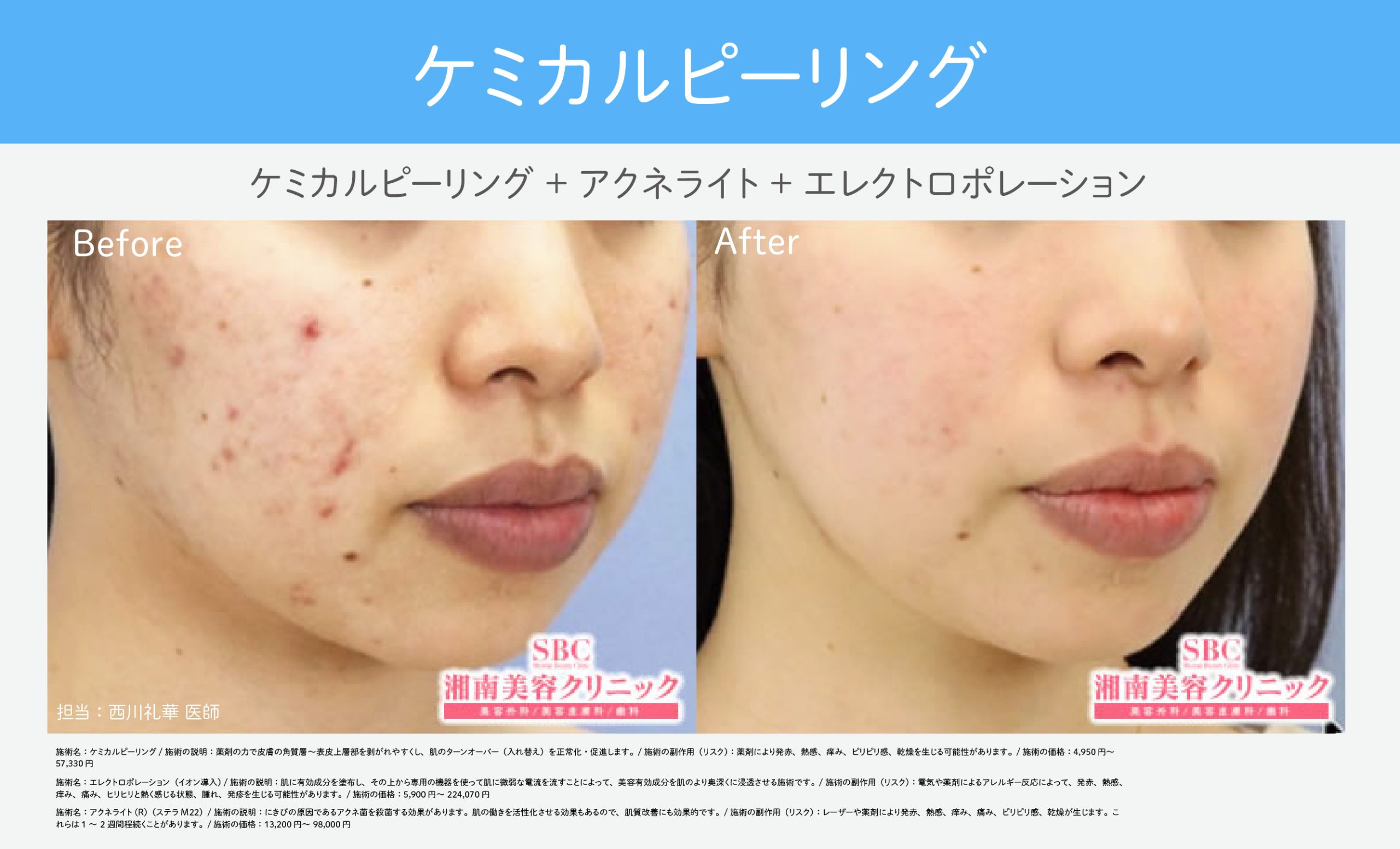 つるんとタマゴ肌へ【ケミカルピーリング】