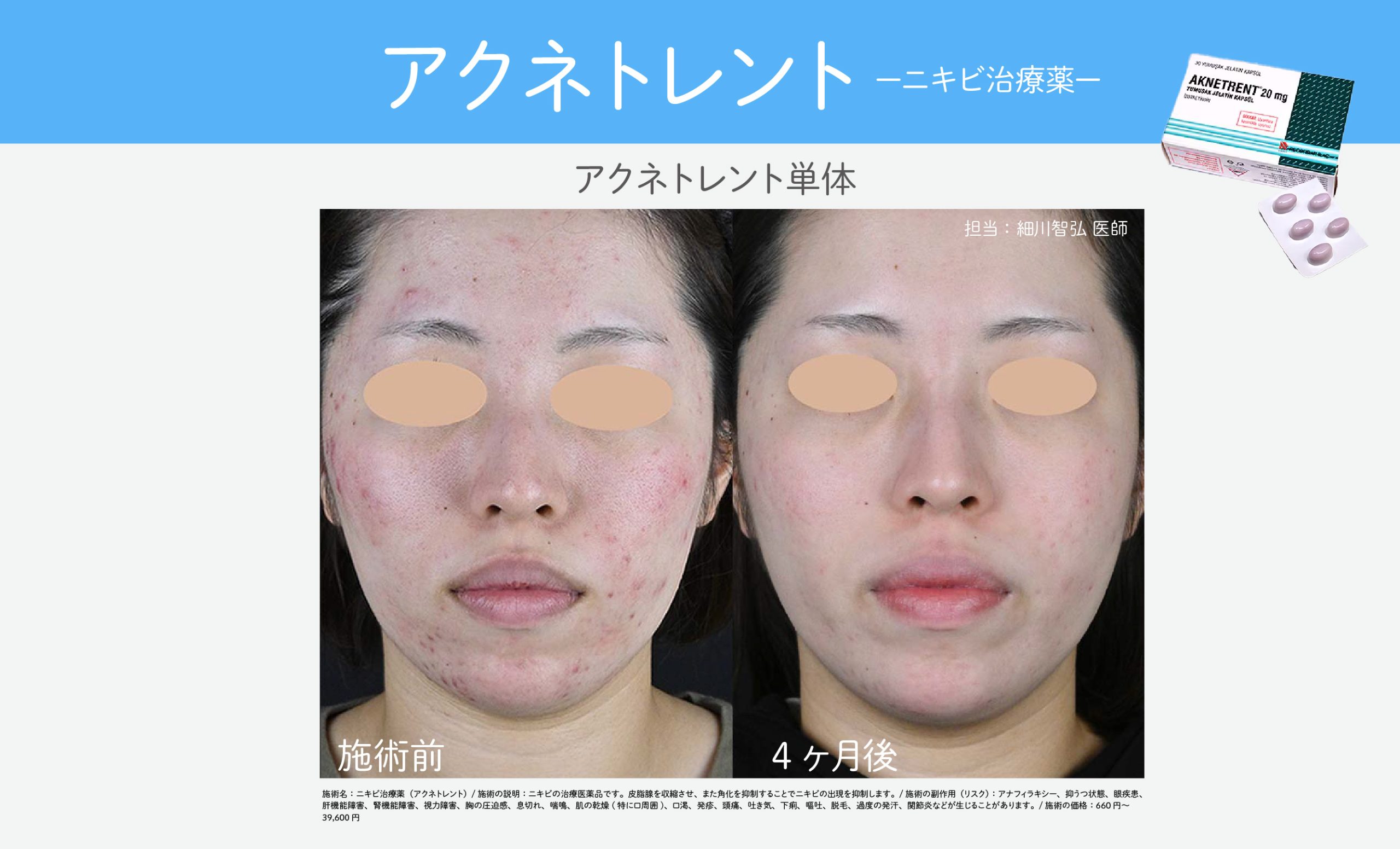 重症ニキビの最後の切り札【アクネトレント（イソトレチノイン）】