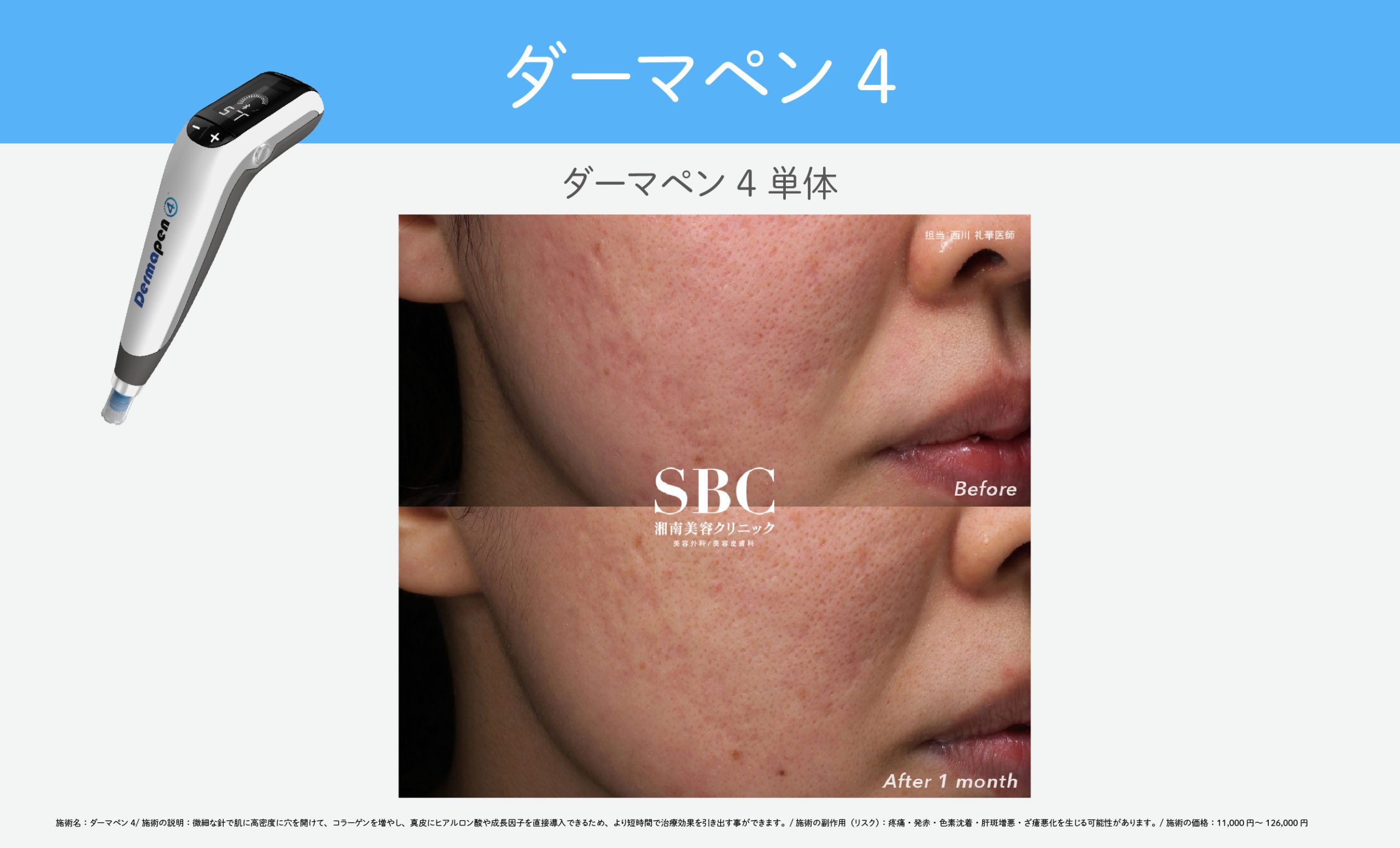 肌再生を促し、クレーターを滑らかに【ダーマペン4】