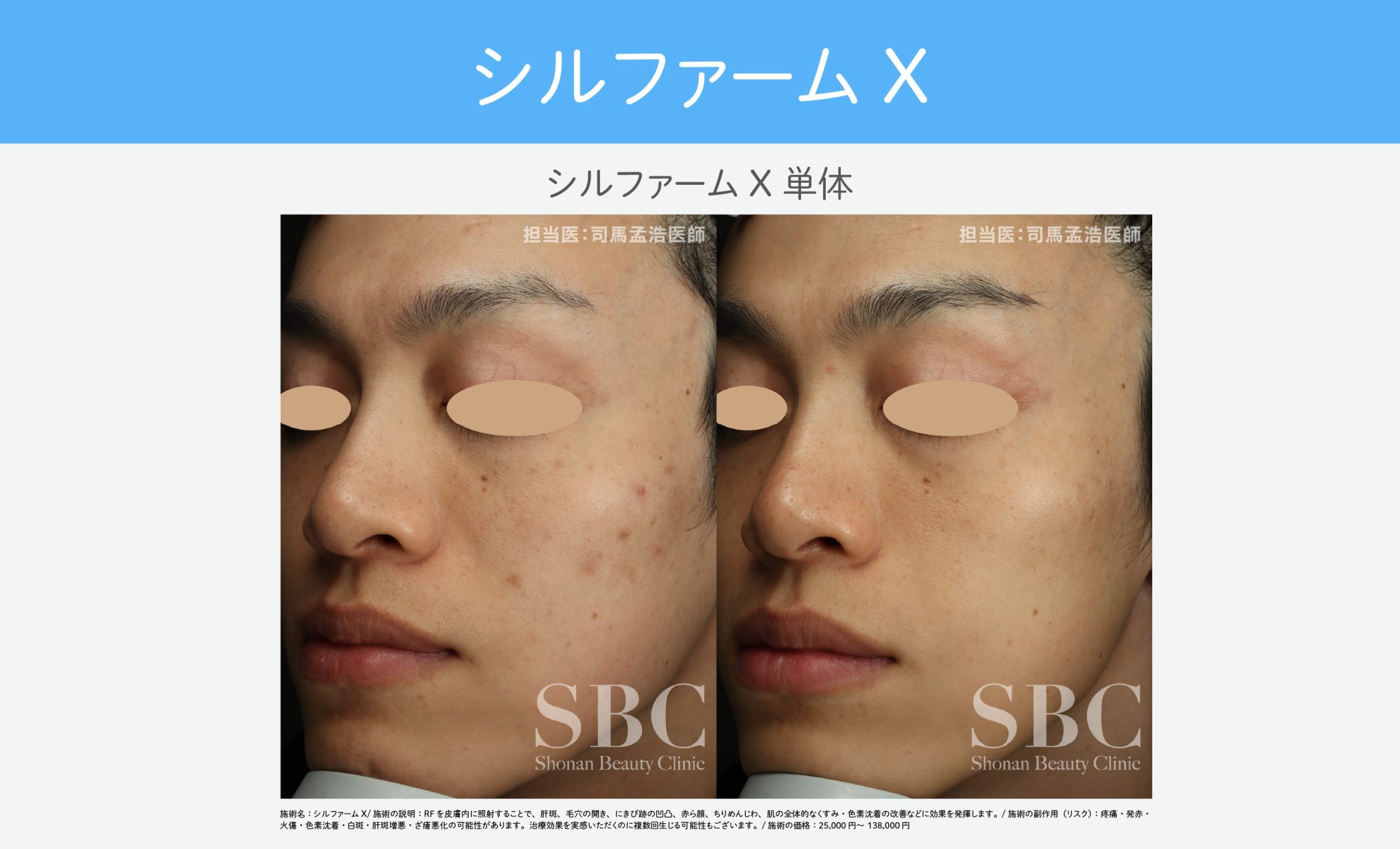 赤みも凹みも同時にアプローチ【シルファームX】