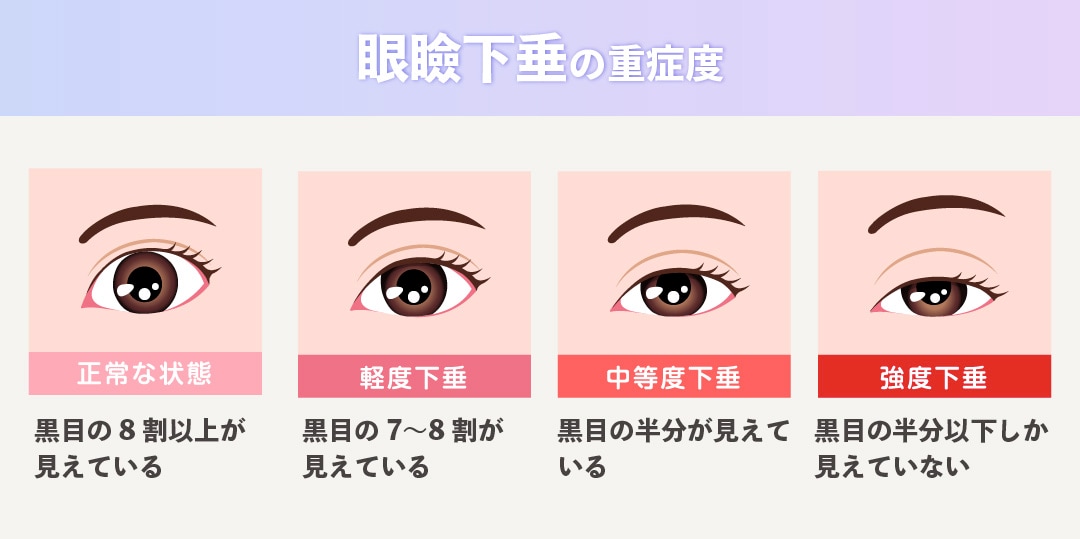 眼瞼下垂をそのままにしておくとダメなの？