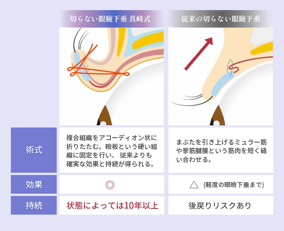 新しい術式「切らない眼瞼下垂真崎式」って？