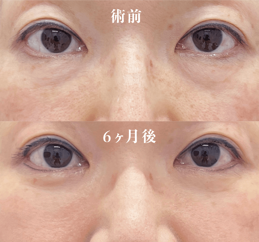 【50代女性】裏ハムラ法