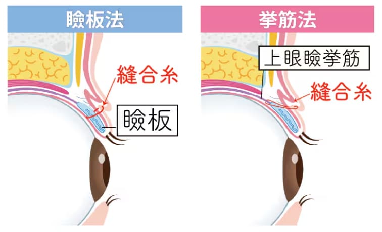 埋没法は挙筋法と瞼板法の2種類ある