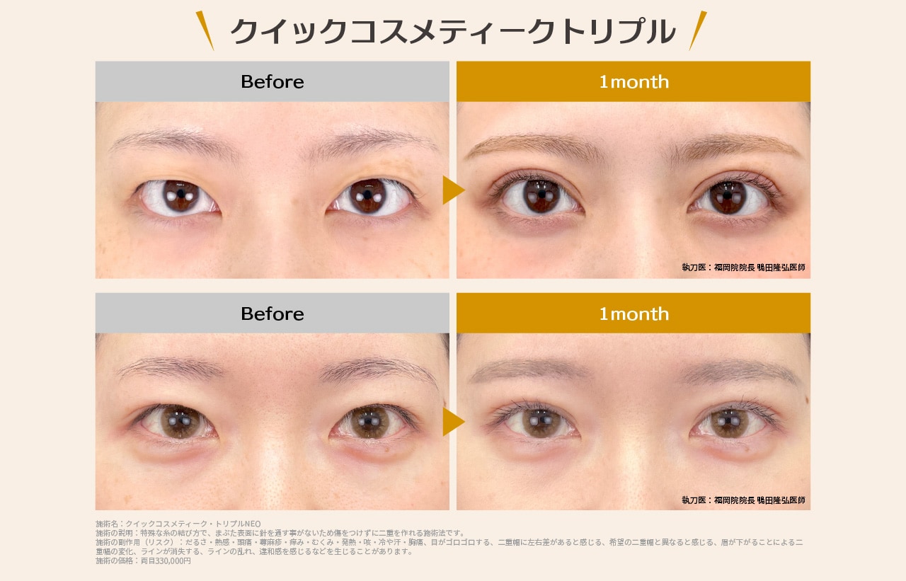 二重埋没(クイックコスメティークトリプル)の症例をご覧ください＾＾