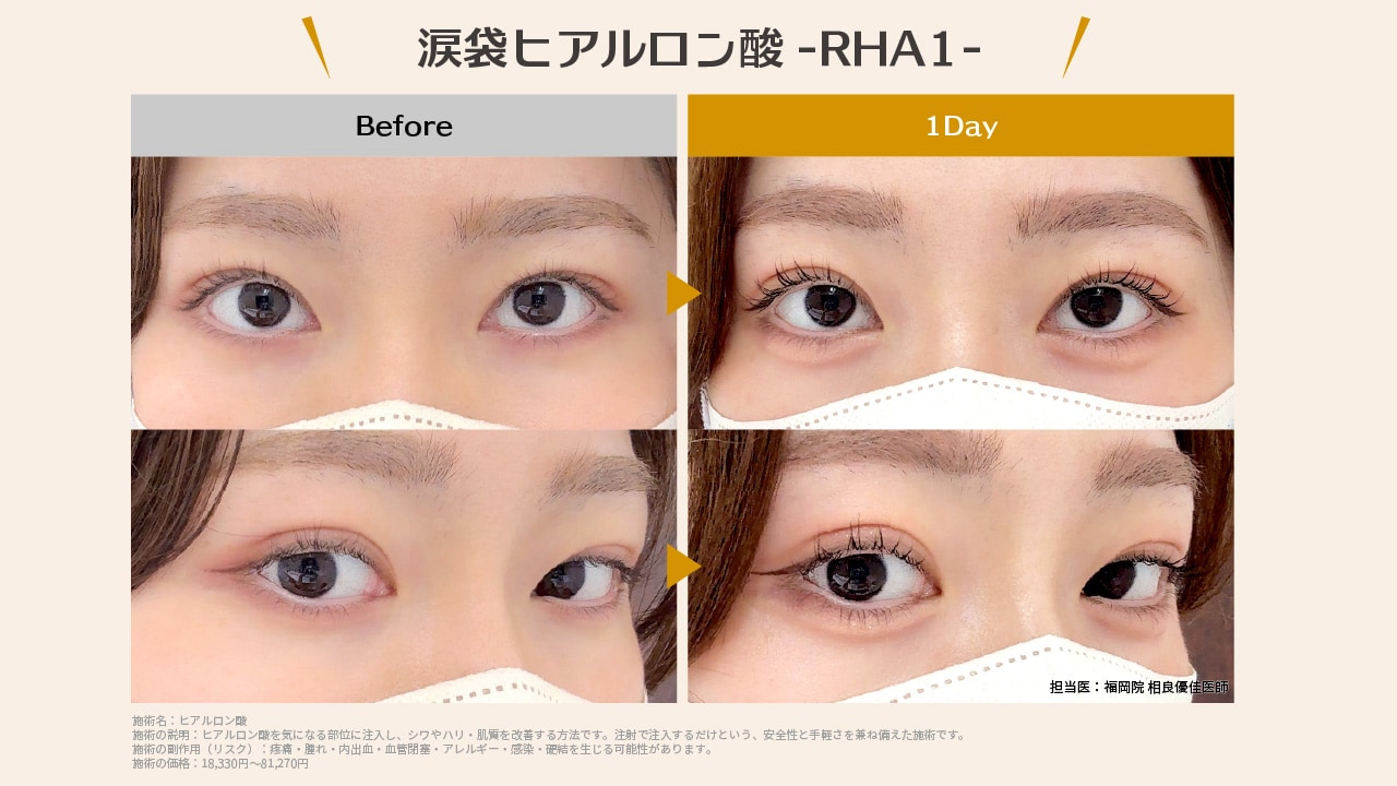 涙袋ヒアルロン酸の症例をご覧ください＾＾