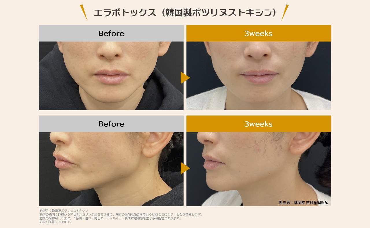 エラボトックスの症例写真をご覧ください＾＾