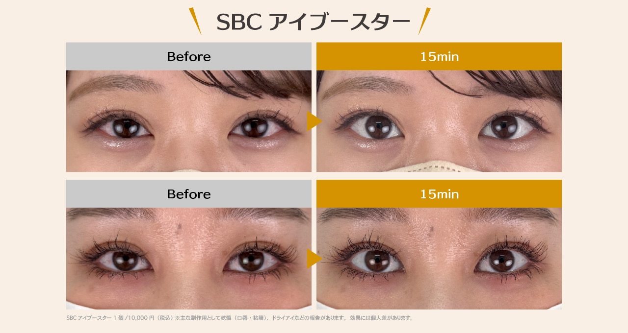 SBCアイブースターの症例をご覧ください＾＾