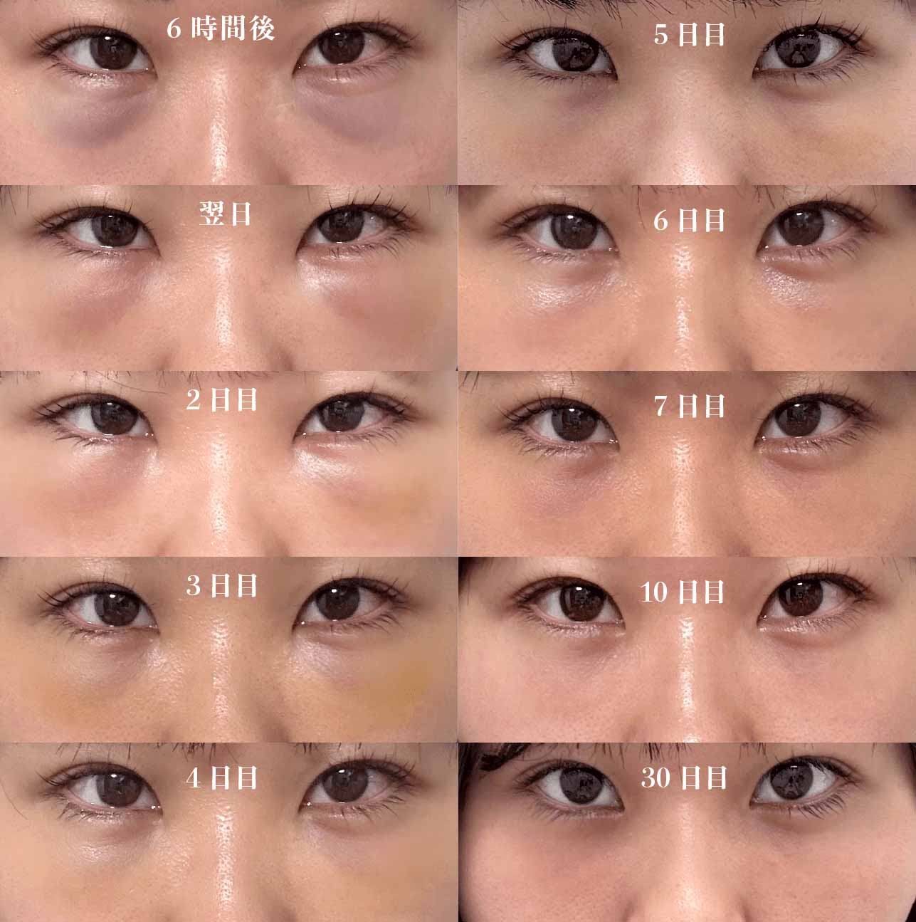 裏ハムラ法のダウンタイム経過