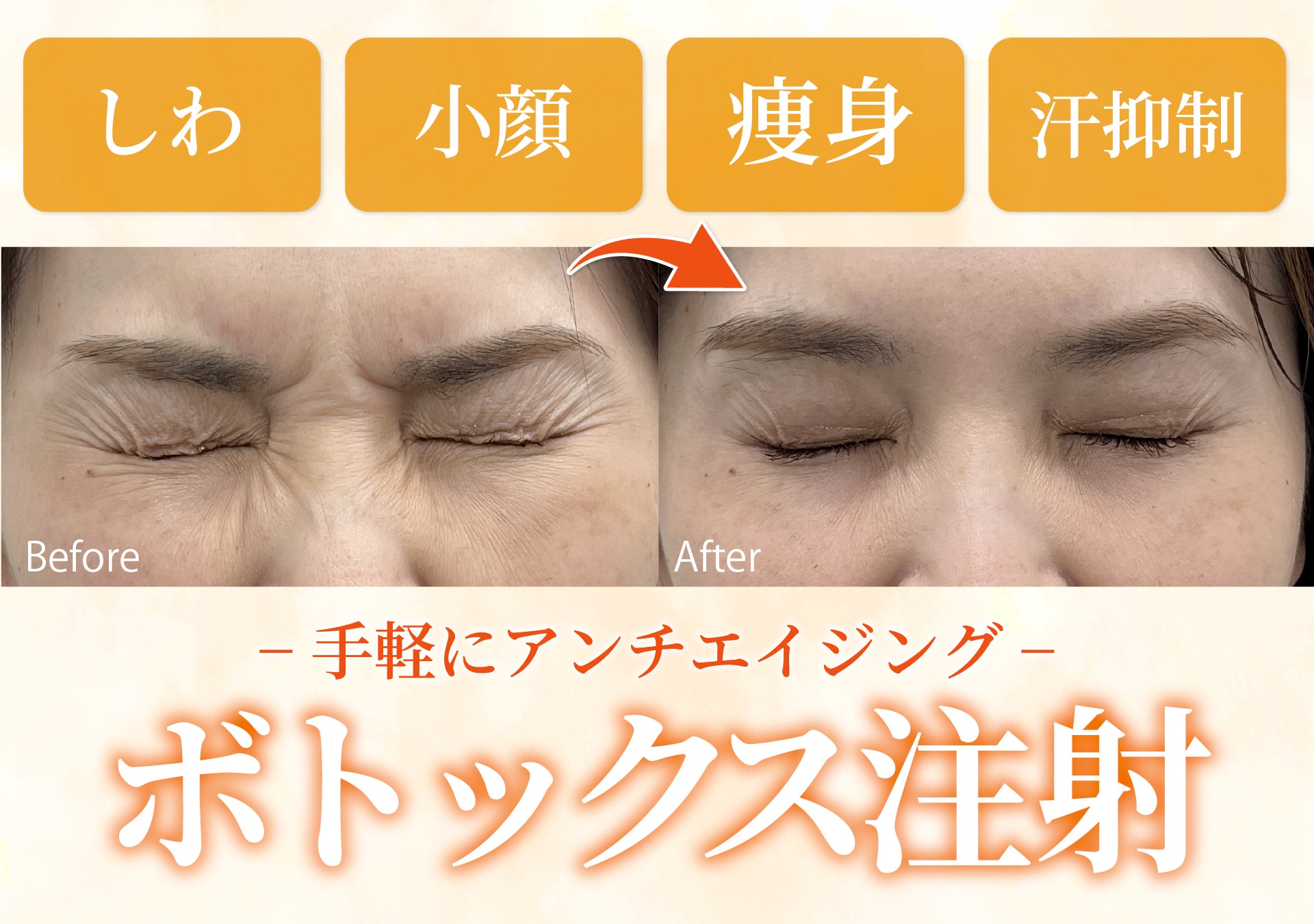 【福岡・天神】【福岡ボトックス】1部位最安2,800円〜しわ予防・若返り！小顔治療や多汗症治療も！福岡でボトックス注射なら上手い先生が揃っている湘南美容クリニック福岡院がおすすめ！｜安い 症例豊富 天神南駅すぐ